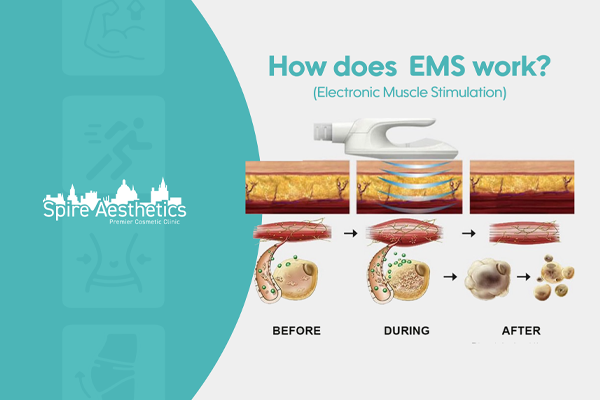 EMS treatment for post pregnancy weight loss treatment Newport