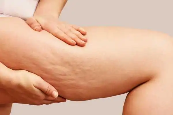 Image of woman showing leg with cellulite Newport