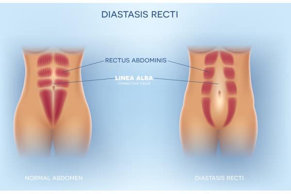 What Non-Surgical Options Are Available for Diastasis Recti Newport?