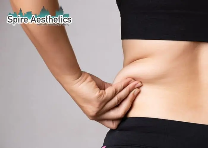 Image of woman pinching fat on their hips Newport. Fat Freezing treatment