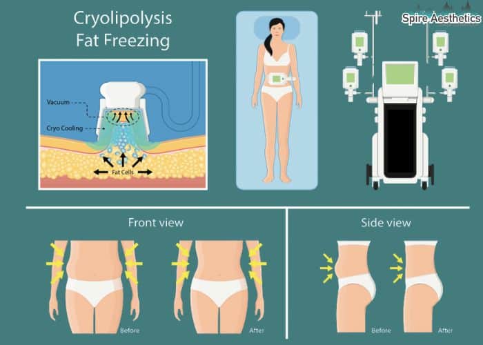 Image of diet and fat freezing combined for best results for Spire Aesthetics Newport