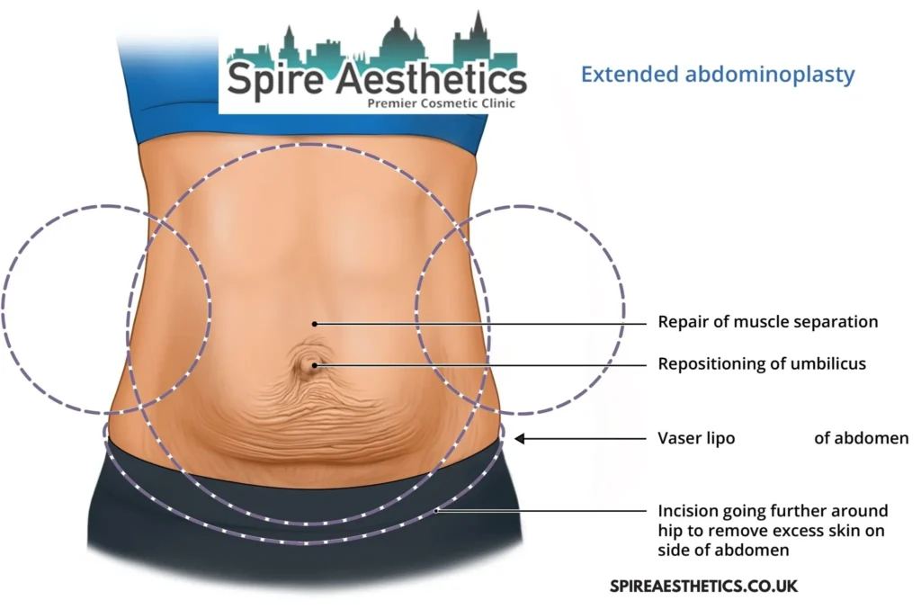 Understanding Loose Skin After Gastric Band Newport Surgery and HIFU Treatment