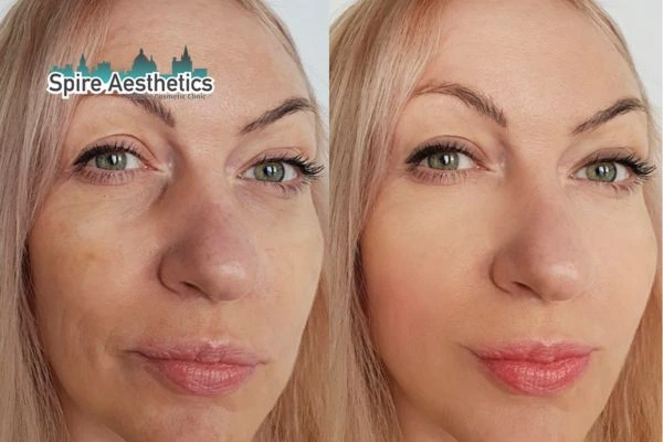 Morpheus8 Treatment Newport Before & After Results