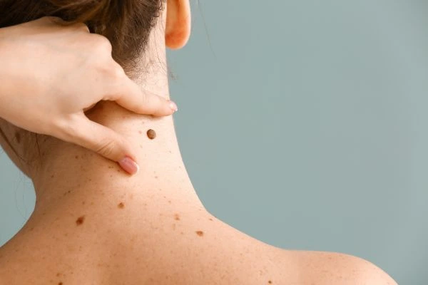 skin blemish removal Newport treatment