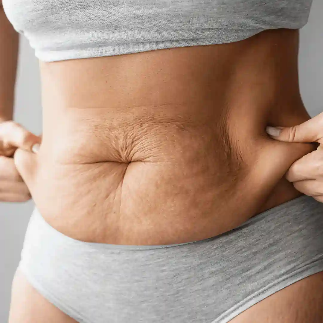 Is It Normal to Have Loose Skin After Pregnancy Newport?