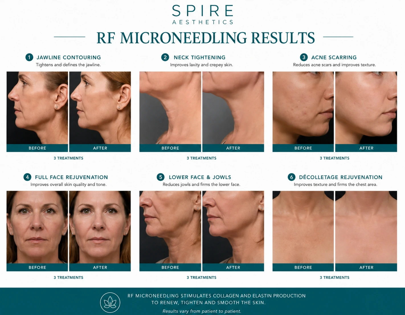 RF Microneedling Skin tightening Newport results