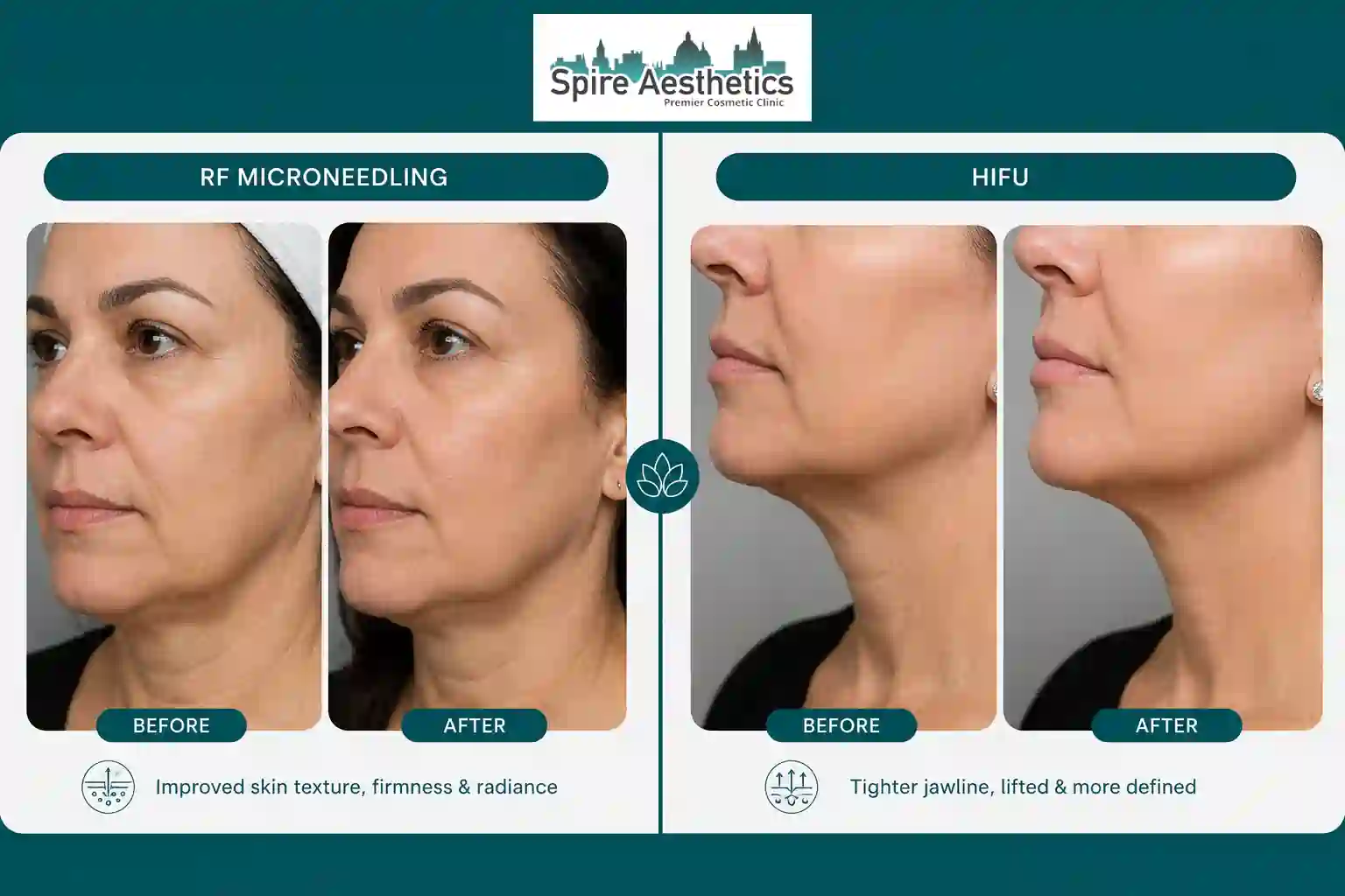Can RF Microneedling and HIFU Be Combined Newport?