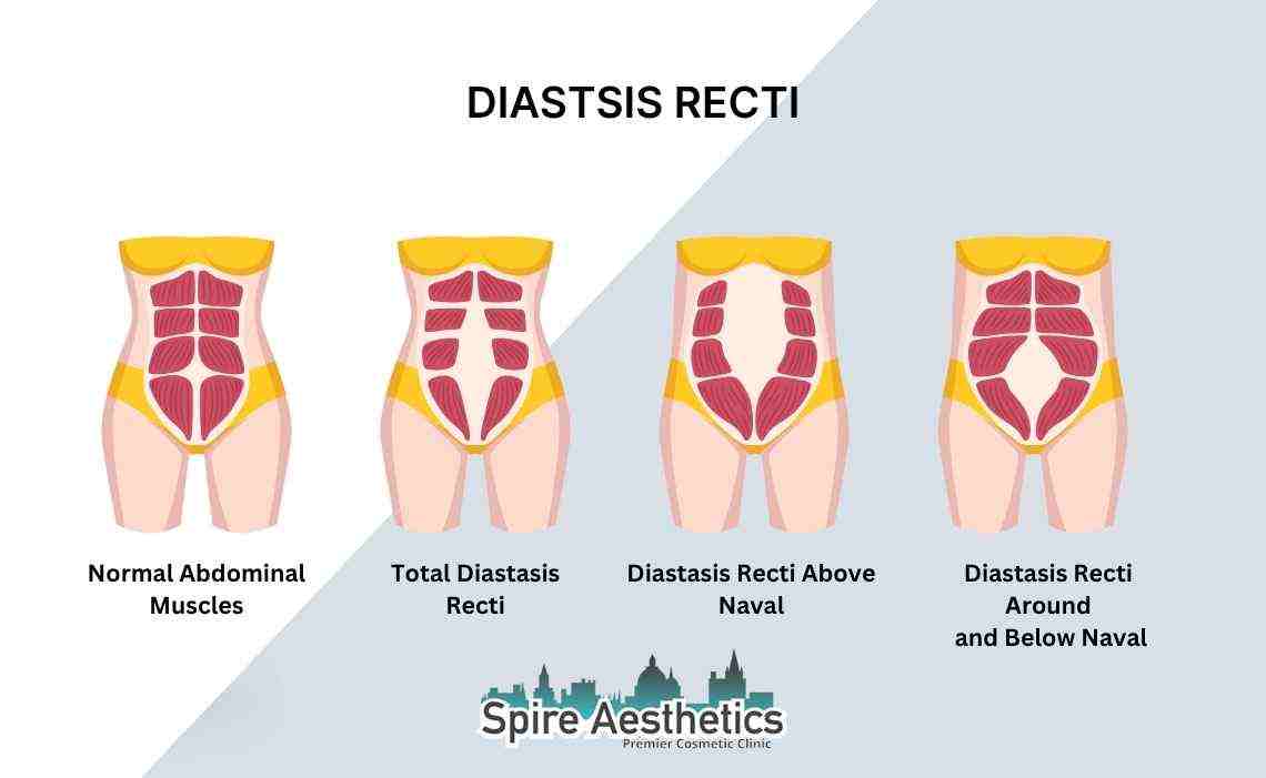 Is Non-Surgical Diastasis Recti Treatment Right for You? Common Concerns Answered Newport